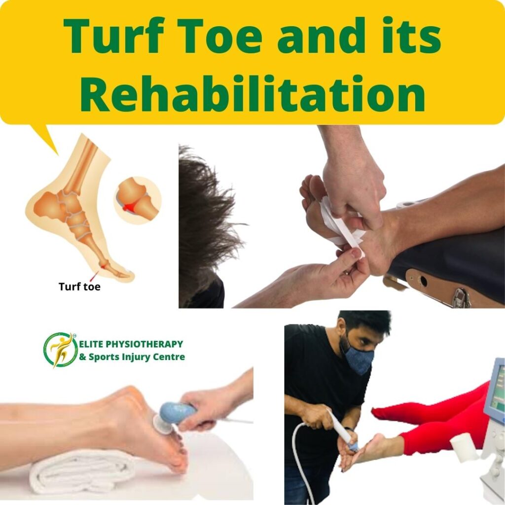 Turf Toe and its Rehabilitation