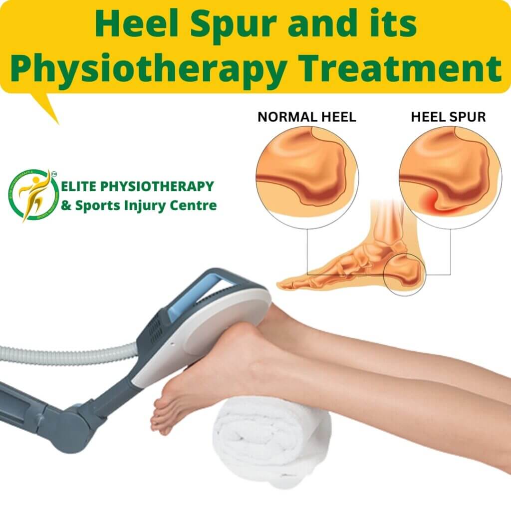 Heel Spur and its Physiotherapy Treatment