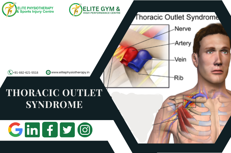 THORACIC OUTLET SYNDROME
