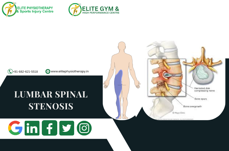 LUMBAR SPINAL STENOSIS