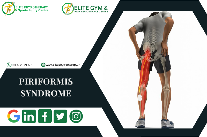Piriformis Syndrome and its Elite Management