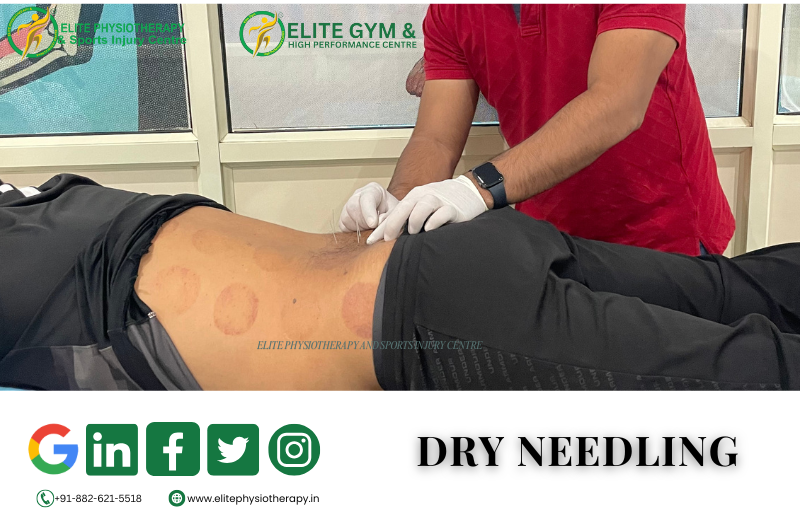 Dry Needling and Its Pain Disappearing Magic